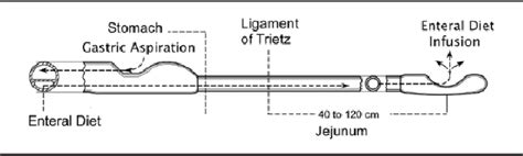 Figure 1 From Dual Purpose Gastric Decompression And Enteral Feeding