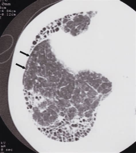 Figure From The Comparison Of High Resolution Computed Tomography