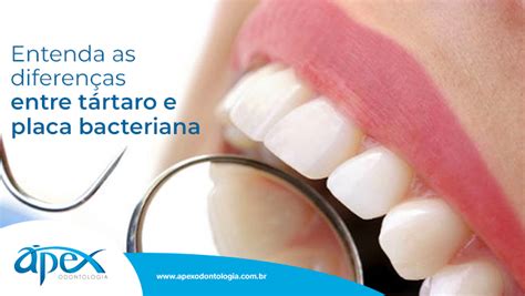 Entenda As Diferen As Entre T Rtaro E Placa Bacteriana Pex Odontologia