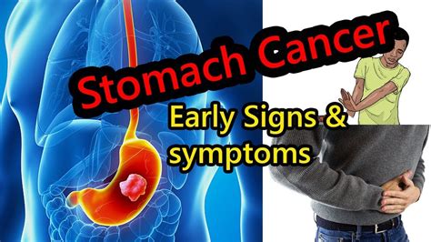 Stomach Cancer Symptoms You Should Not Ignore Youtube