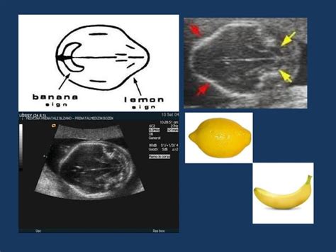 Prenatal myelomeningocele treatment and diagnosis