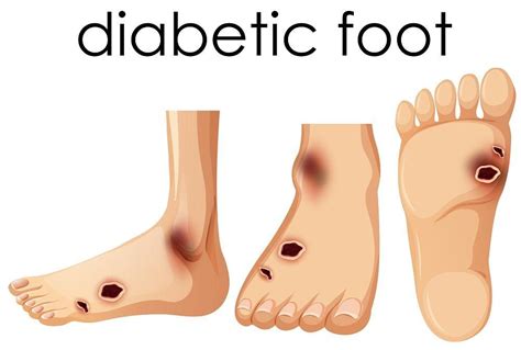 Diabetic Foot Ulcer Amputation