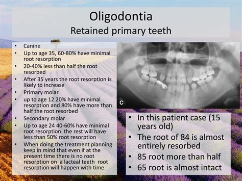 PPT - Oligodontia PowerPoint Presentation, free download - ID:1872529