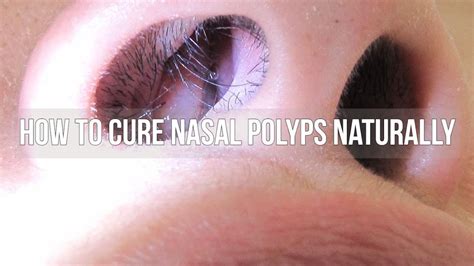 [nasal Polyps Removal] How To Cure Nasal Polyps Naturally Youtube