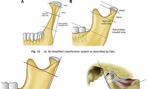 Mandibular Fracture Classification