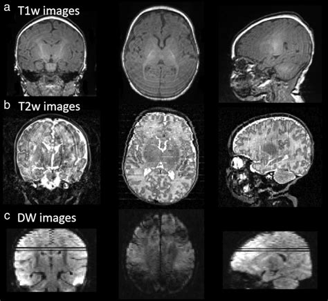 Typical Motion Artifacts On Newborn Images Artifacts Are Presented In