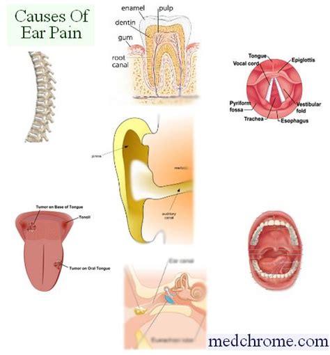 Causes Of Earache Or Otalgia Medchrome