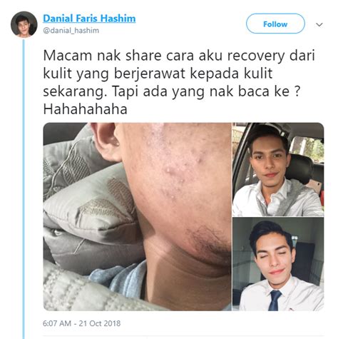 Dapat Ribuan Retweet Lelaki Ini Kongsi Cara Pulih Dari Breakout Dengan