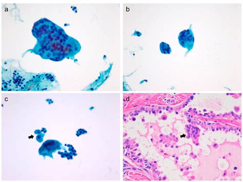 Cytologic features and corresponding histology of multinucleated giant... | Download Scientific ...