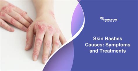 Understanding And Managing Skin Rashes Causes Symptoms Treatments