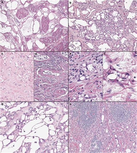 Adenomatoid Tumors Of The Female And Male Genital Tracts A