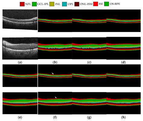 A Novel Intraretinal Layer Semantic Segmentation Method Of Fundus OCT