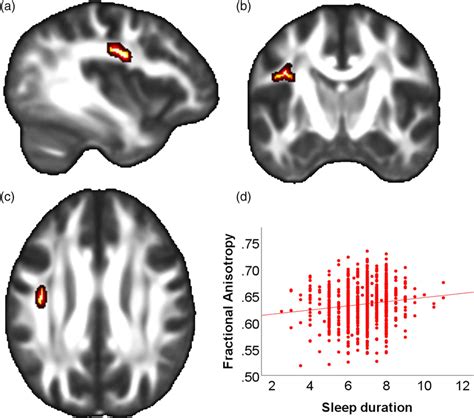 Association Of Sleep Duration And Fractional Anisotropy In The Left