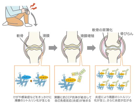 抗ccp抗体陽性 築地リウマチ膠原病クリニック