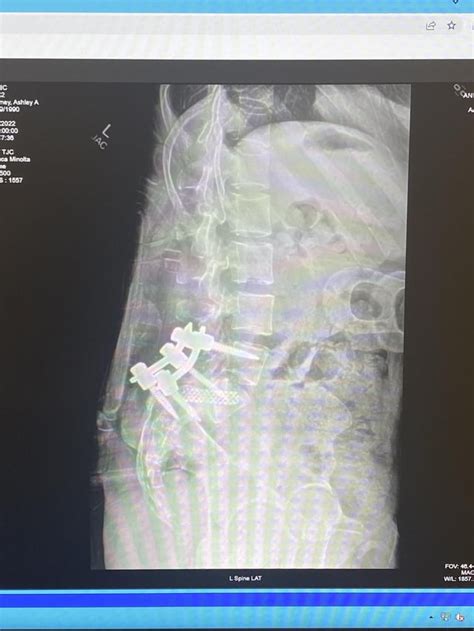 12/30 photo update from l4-l5-s1 fusion surgery on 12/19 : r/spinalfusion