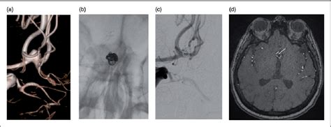 Figure From Stent Assisted Coil Embolization Of Anterior