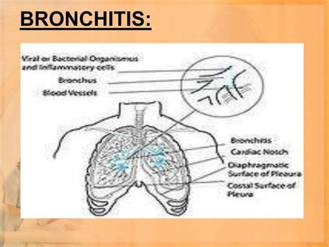 Lower Respiratory Tract Infections Ppt Ppt