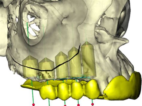 Preoperative Three Dimensional Planning And Virtual Implant Placement Download Scientific