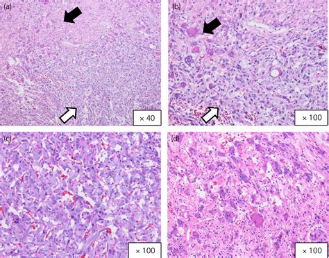 Composite Pheochromocytoma Associated With Neurofibromatosis Type 1 Tachibana 2023 Iju