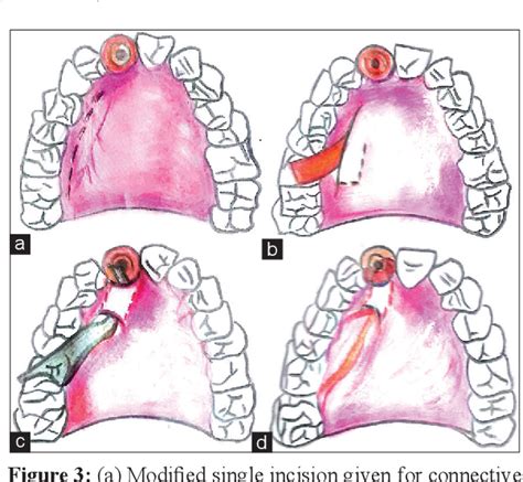 Figure 4 from Palatal pedicle flap-varied applications | Semantic Scholar