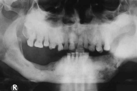 Osteomyelitis In The Mandible Download Scientific Diagram