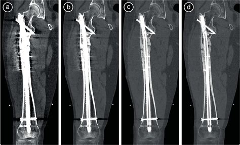 Metal Artifact Reduction Techniques In Musculoskeletal Ct Imaging