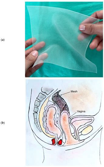 Biomedicines Free Full Text Polypropylene Pelvic Mesh What Went