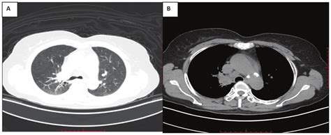 A Chest Computed Tomography Image Showing A A 2 3x2 2 Cm Hypodense