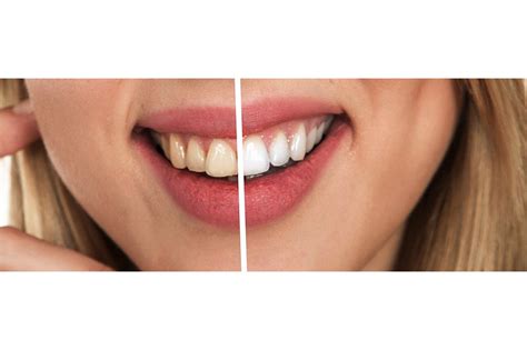 Consejos A Tener En Cuenta Antes De Hacerse Un Blanqueamiento Dental