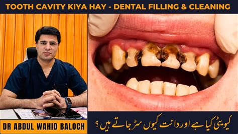 Tooth Cavity Urdu Hindi Dant Dard Ka Ilaj Dental Filling Cleaning