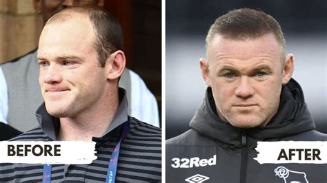 Exploring Wayne Rooney's Hairline: A Comparative Analysis of Hair ...