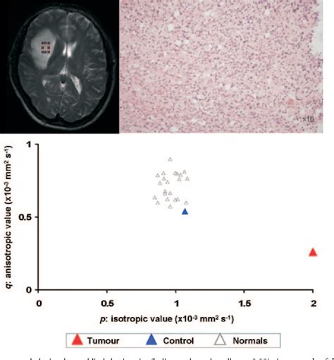 Figure From Improved Delineation Of Glioma Margins And Regions Of