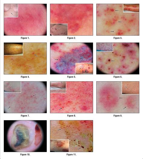 Pigmented purpuric dermatosis | Semantic Scholar