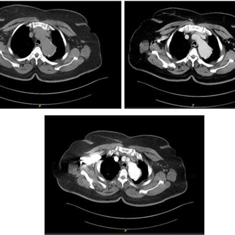 Preoperative CT Angiography Showing Large Descending Thoracic Aortic