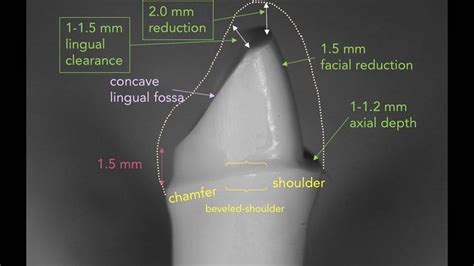 Dentalschool🥇 (@denta_lschool) posted on Instagram: “Preparing Anterior Teeth for PFM Crowns For ...