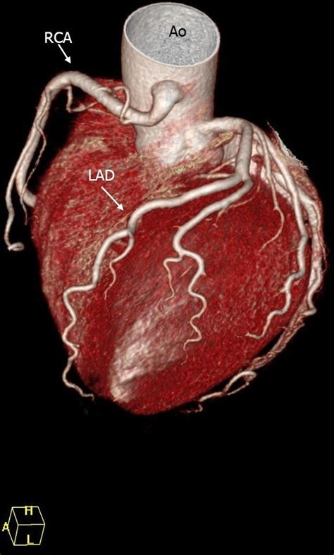 The Prevalence Of Coronary Anomalies In A Single Center Of Korea