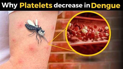 Dengue Fever Part 1 Why Platelets Decrease In Dengue Dengue Fever