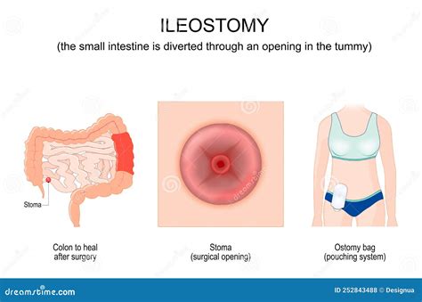 Ileostomy Close Up Of A Stoma Stock Vector Illustration Of Health