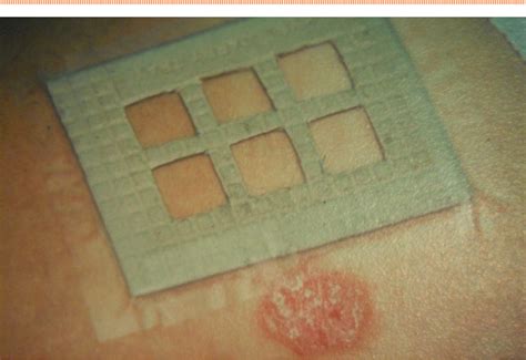 Figure 2 From Minimal Erythema Dose Testing Made Easy With Excimer Laser Semantic Scholar