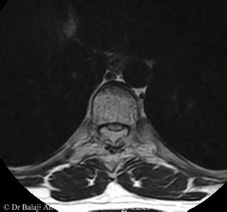 VERTEBRAL BODY HEMANGIOMA MRI RADIOLOGY - Wroc?awski Informator Internetowy - Wroc?aw, Wroclaw ...