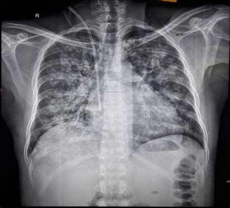 Leptospirosis Rash