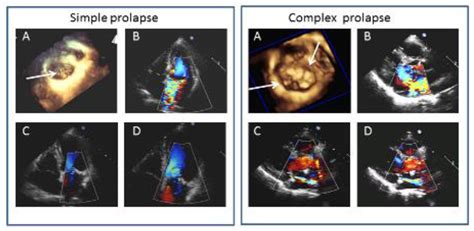 Jcdd Free Full Text Predictive Value Of Pre Operative 2d And 3d