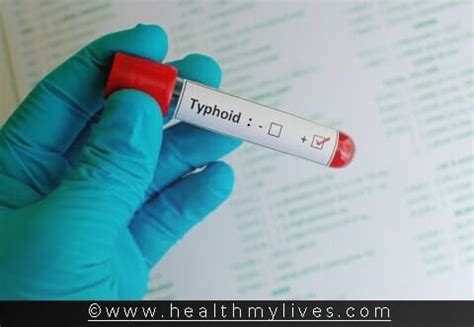 Typhoid - Symptoms, Causes, Treatment, And Prevention