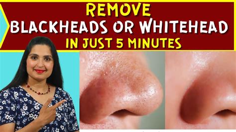 How To Remove Blackheads Whiteheads At Home Easy Face Mask Clears