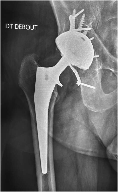 Survival And Clinical Outcomes At 30 To 35 Years Following Primary Total Hip Arthroplasty With A