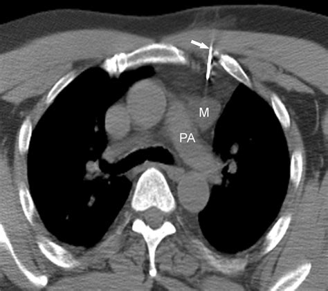 Imaging Guided Percutaneous Biopsy Of Mediastinal Lesions Different