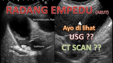 Gambaran USG Dan CT Scan Cholecystitits Akut Radang Empedu YouTube