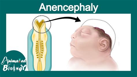 Anencephaly Neural Tube Defects Folate Deficiency Usmle Youtube