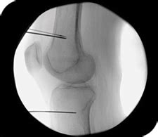 Knee Pain Radiofrequency Treatment Genicular Neurotomy Jaipur Pain