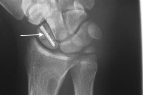 Scaphoid Nonunion Hand Surgery Resource